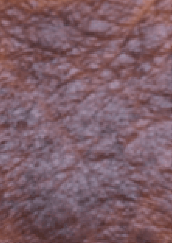 Darkening of the skin due to moderate-to-severe eczema.
