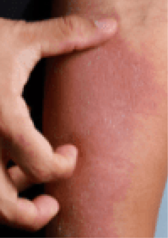 Reddening of the skin due to moderate-to-severe eczema.