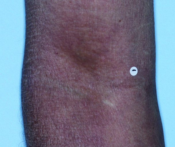 Comparison of inflamed skin on arms with atopic dermatitis (eczema) before and after Adbry® treatment.