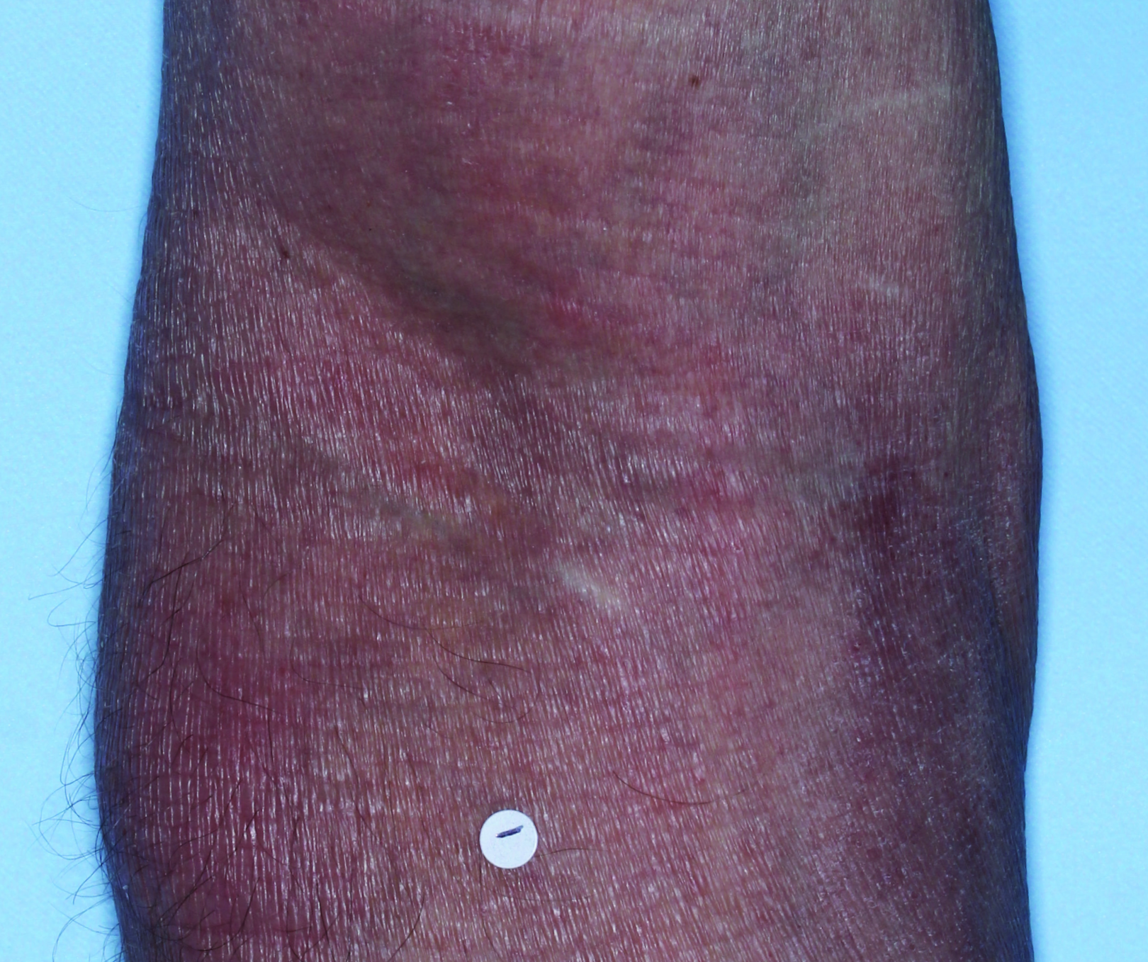 Comparison of inflamed skin on arms with atopic dermatitis (eczema) before and after Adbry® treatment.