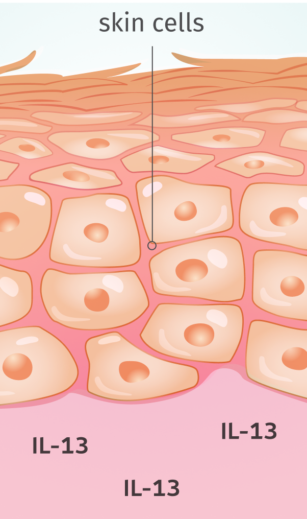 Adbry® (tralokinumab-ldrm) treated skin with the skins cells and lowered IL-13.